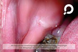 Dermanostic Hautlexikon Leukoplakie Weissschwielenkrankheit