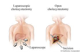 The laparoscopic surgery also denoted to as slightly hostile surgery that defines the enactment of surgical techniques with the help of a video camera and several thin. Laparoscopic Gallbladder Surgery For Gallstones