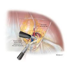 Image result for Hernia Reduction