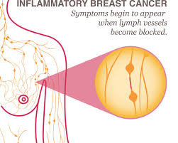 Image result for Inflammatory breast cancer