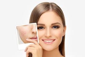 5 Ways To Naturally Get Rid Of Acne Scars Vitalskin Dermatology