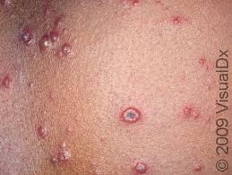 Image result for chickenpox