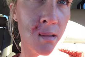 Horrific damage caused by sunbeds as women left with…