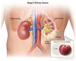 The most common and early sign of kidney cancer is blood in the urine or hematuria. Renal Cell Cancer Treatment Pdq Patient Version National Cancer Institute