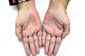 Pictures and symptoms of the. Palmar Erythema Keyword Search Science Photo Library