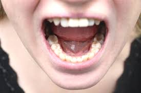 Image result for gums cancer symptoms