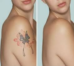 Lazerle Dovme Silme Karbon Peeling Dovme Epilasyon Tattoo