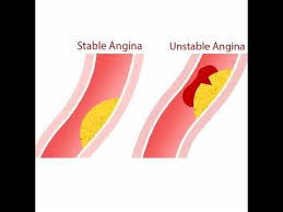 Image result for Unstable Angina