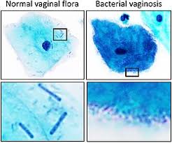 Image result for Vaginitis