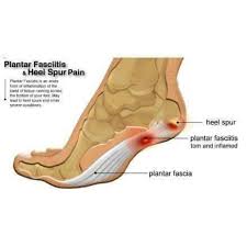 Tekanan yang berlebihan di tumit disebabkan oleh kelemahan otot hamstring dan sendi lutut yang terlalu kebelakang. Minyak Kutus Kutus Solusi Herbal Nyeri Tumit Shopee Indonesia