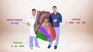 But i've seen people with elevated troponin walk out of the ed same day and. Ecg For Beginners Ecg Diagnosis Of St Elevation Myocardial Infarction Stemi Youtube