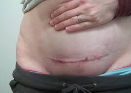 Your wound will take about 6 weeks to heal. C Section Infection New Kids Center