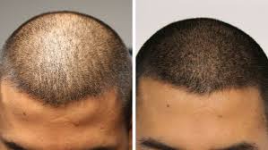 What is a hairline tattoo? Hair Tattoo What Is Scalp Micropigmentation Cost Before After Pics