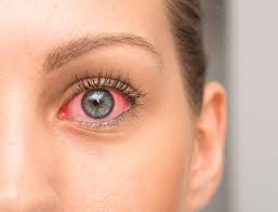 We did not find results for: Vorsicht Vor Pollenflug Bei Neurodermitis Gesundheitsoptik