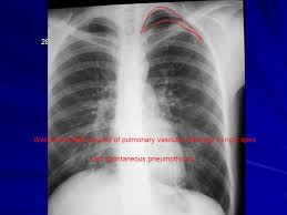 Find answers to frequently asked questions about viewing radiology results on my healthevet. X Ray Rounds Plain Chest Radiographs Ppt Video Online Download