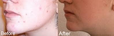 Revive Light Therapy Acne Treatment Handheld System Product Review Beauty Realty Your Home For The Best Beauty Products