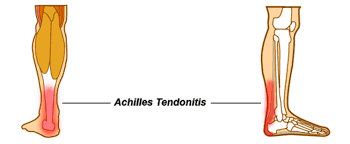 Shop our wide selection of physical therapy equipment at great prices. Top Facts About Achilles Tendon Pain Tendonitis And Achilles Rupture