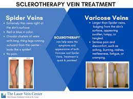 Is Sclerotherapy Vein Treatment Right For You Laser Vein Center