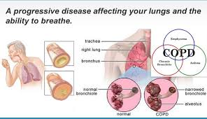 This makes it hard for air to flow in and out. Copd Applied Chest Imaging Laboratory