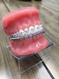 Here are some of the best ways to relieve soreness from braces. Advanced Treatment With The Forsus Appliance