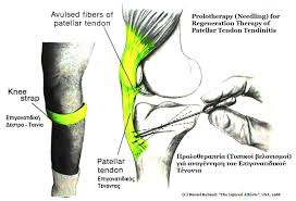 This problem is most often seen in athletes who do repetitive jumping—the reason patellar tendonitis is often called jumper's knee. Important Facts About Patellar Tendonitis And Shoulder Tendonitis Writework