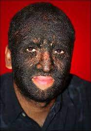 Find out werewolf syndrome pictures, hypertrichosis pictures, werewolf syndrome symptoms, hypertrichosis it seems impossible but there really is a condition called werewolf syndrome. Wolf Boy Larry Gomez Hopes New Genetic Findings Can Cure Werewolf Syndrome Huffpost
