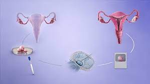 In Vitro Fertilisation Wikipedia