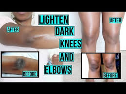 We did not find results for: How To Get Rid Of Dark Spots On Legs Amp Body Fast Get Clear Even Skin Tone All Over You How To Lighten Dark Knees Lighten Dark Knees Skin Care Remedies