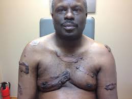 Keloids scars can be a nuisance because they continue to grow even after the scar has healed. Keloids Springerlink