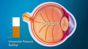 Image result for Intraocular Pressure