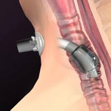 Image result for Tracheostomy