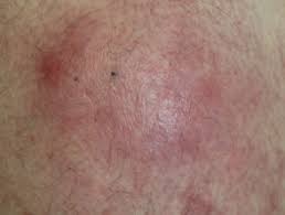 Aspergillosis occurs in humans, birds and other animals. Aspergillosis Dermnet Nz