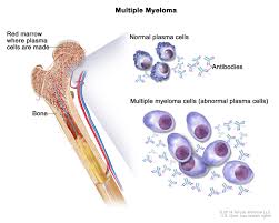 Medical illustration of multiple myeloma: bone marrow with plasma cells compared to normal versus abnormal plasma cells and antibodies