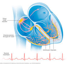 Premature Ventricular Contractions Pvcs Symptoms And Causes Mayo Clinic 10 1 20 Dr Swofford Thinks Sinusitis Sinus Tachycardia Congenital Heart Disease