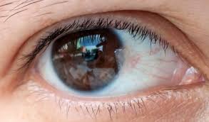 Mata juling atau dalam istilah medis dikenal dengan strabismus terjadi akibat adanya gangguan koordinasi pada otot penggerak bola mata. Dewasa Sunway Eye Centre Eye Specialists In Malaysia