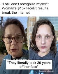 I still don't recognize myself": Woman's $15k facelift results break the  internet: