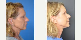 RealSelf: Andre Levesque, MD