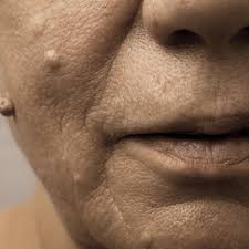 Atau mungkin memiliki biji kolesterol di kawasan hidung, mata, leher, atau di muka? Cara Menghilangkan Kutil Di Wajah Dengan Bahan Alami Hot Liputan6 Com