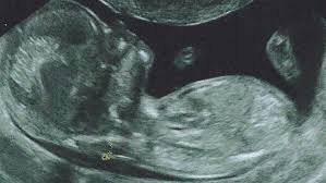 El síndrome de down puede estar causado por uno de los tres tipos de la división de células anormal envolviendo la cromosoma 21. Sindrome De Down Caracteristicas Causas Esperanza De Vida Diagnostico Y Definicion