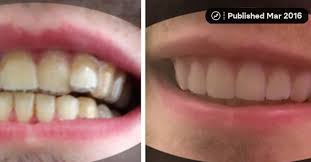 I'm 40 years old, and i'm in braces. Here S How A College Student Created His Own Braces For Less Than 60