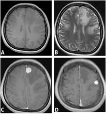 Image result for Neurosyphilis