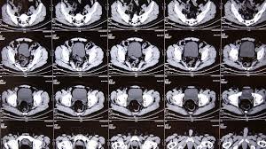 It can show large, more advanced cancers or masses.. Could Ct Scans Cause Cancer Cnn