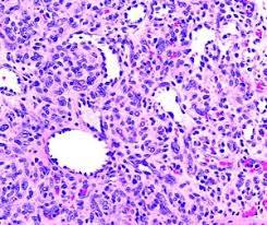 Image result for Pyogenic Granuloma