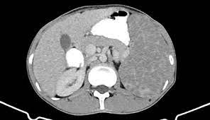 Splenic Granulomatous Disease Radiology Reference Article Radiopaedia Org