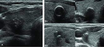 Thyroid calcification is frequent in thyroid nodules. Transverse Ultrasound Image Of Thyroid Nodules With Calcifications A Download Scientific Diagram