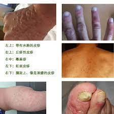 #魏嘉宏皮膚科診所 #冷凍溶脂 #一週年慶 #洢蓮絲 #原廠玻尿酸 #原廠肉毒 #皮秒蜂巢複合式療程 #雙眼皮手術 #眼袋手術 #埋線 #鳳凰電波 #美國音波 #精緻除毛 #hpv疫苗 #. ç´…ç–¹ æ°´ç—˜ ç˜€é'éƒ½å¯èƒ½æ˜¯æ–°å† è‚ºç‚Žç—‡ç‹€ åˆä½µç™¼ç‡' è…¹ç€‰è¦é¦¬ä¸Šå°±é†« Hehoå¥åº·