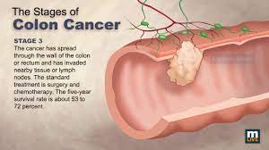 Sometimes colon or rectal cancer is found before it causes symptoms. Stages Of Colon Cancer Youtube