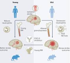 Image result for Stroke Pathophysiology