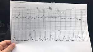 Bei der geburt selbst werden meist in regelmäßigen abständen ctgs gemacht, um vor allem die reaktion des ungeborenen babys auf die wehen zu beobachten. Ubungswehen Braxton Hicks Kontraktionen Geburtswehen Juni 2017 Babyclub Seite 17 Babycenter