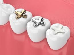 Tooth Colored Filling